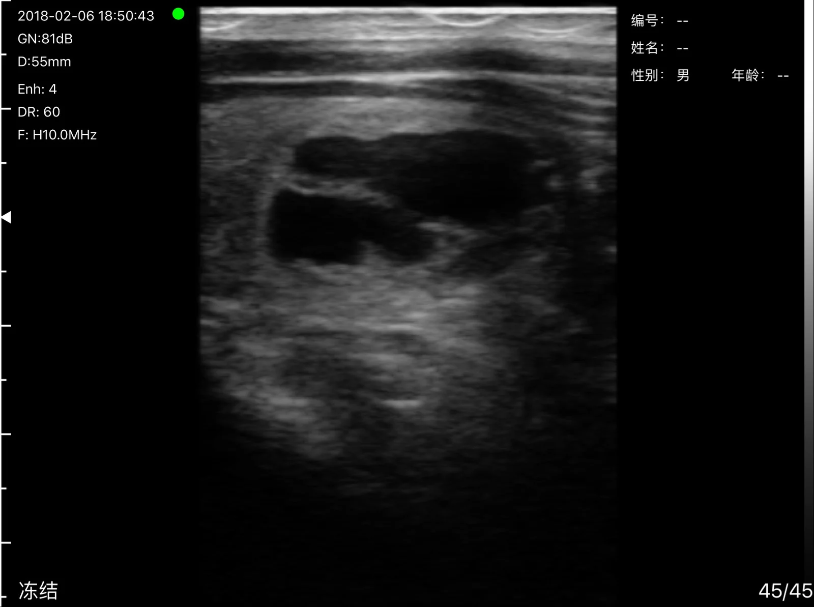 Cystic and solid nodule at 55 mm