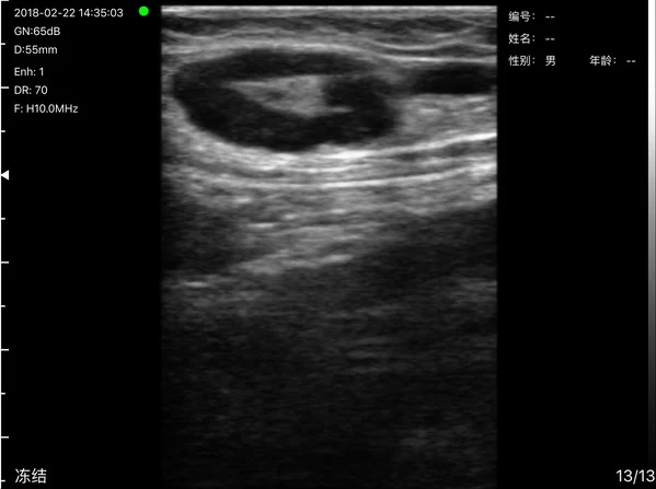 Cervical node with an echogenic hilum