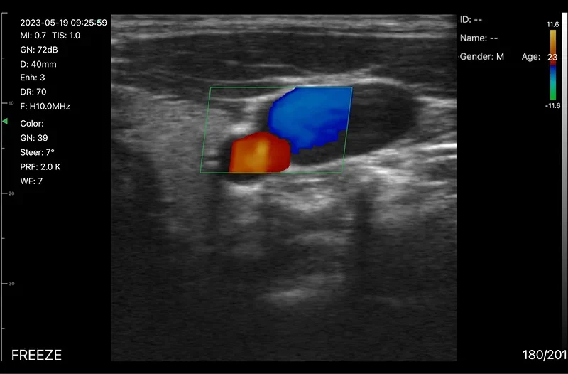Neck vessels in color on the D3Ultra