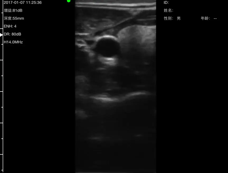 Thyroid sweep on a Suresult handheld