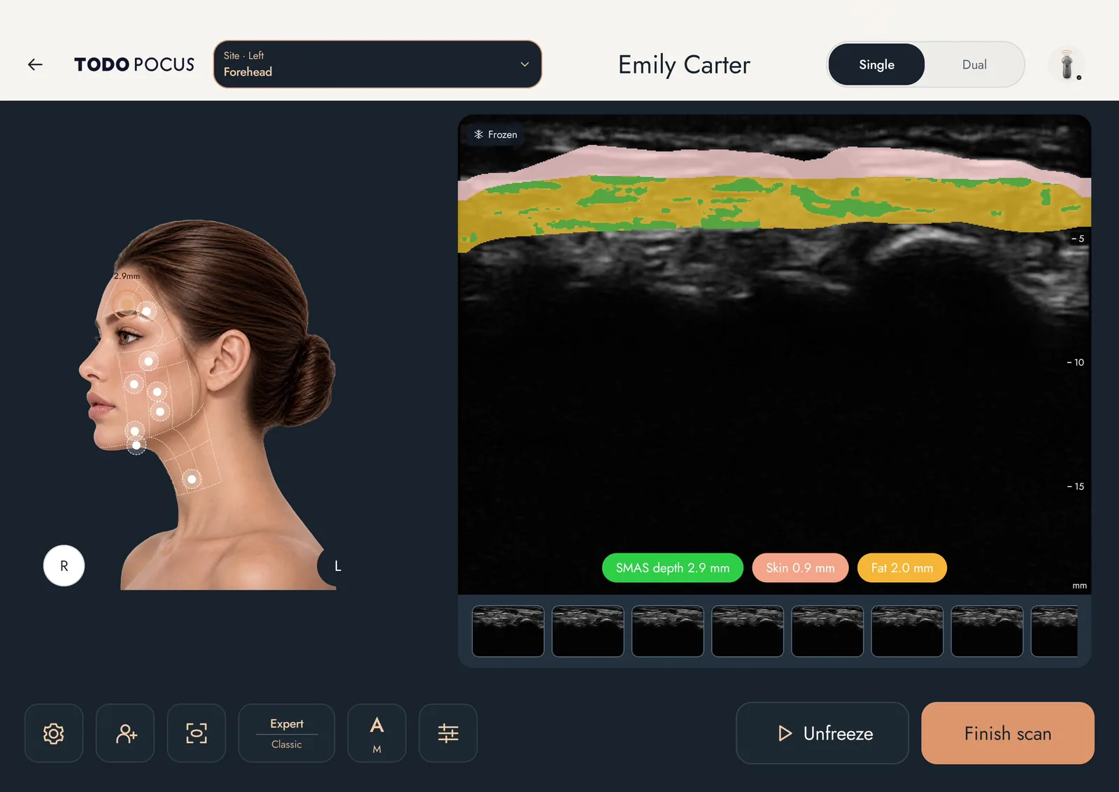 FaceAtlas AI 전문가 모드의 측면 안면 매핑 부위