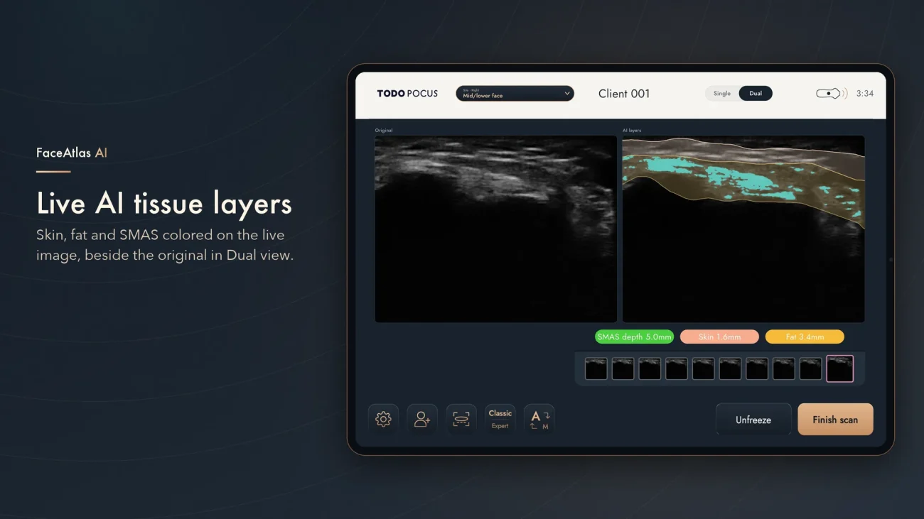 FaceAtlas AI in Dual-view: origineel echobeeld naast AI-lagen voor huid, vet en SMAS