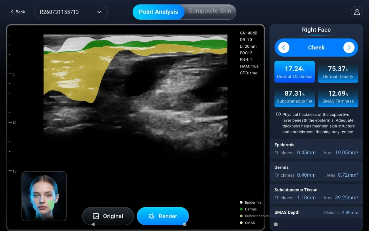 FacialAI point analysis of a B-mode capture with epidermis, dermis, subcutaneous tissue and SMAS segmented