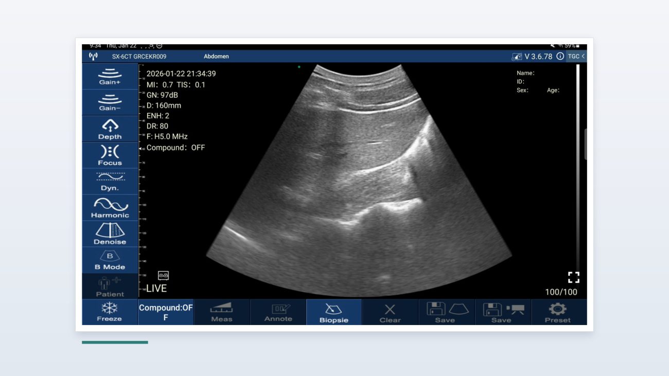 Suresult D3Ultra handheld ultrasound interface showing a right upper quadrant scan: liver, right kidney and the hepatorenal recess, with the Abdomen preset, 160 mm depth and 97 dB gain on the panel