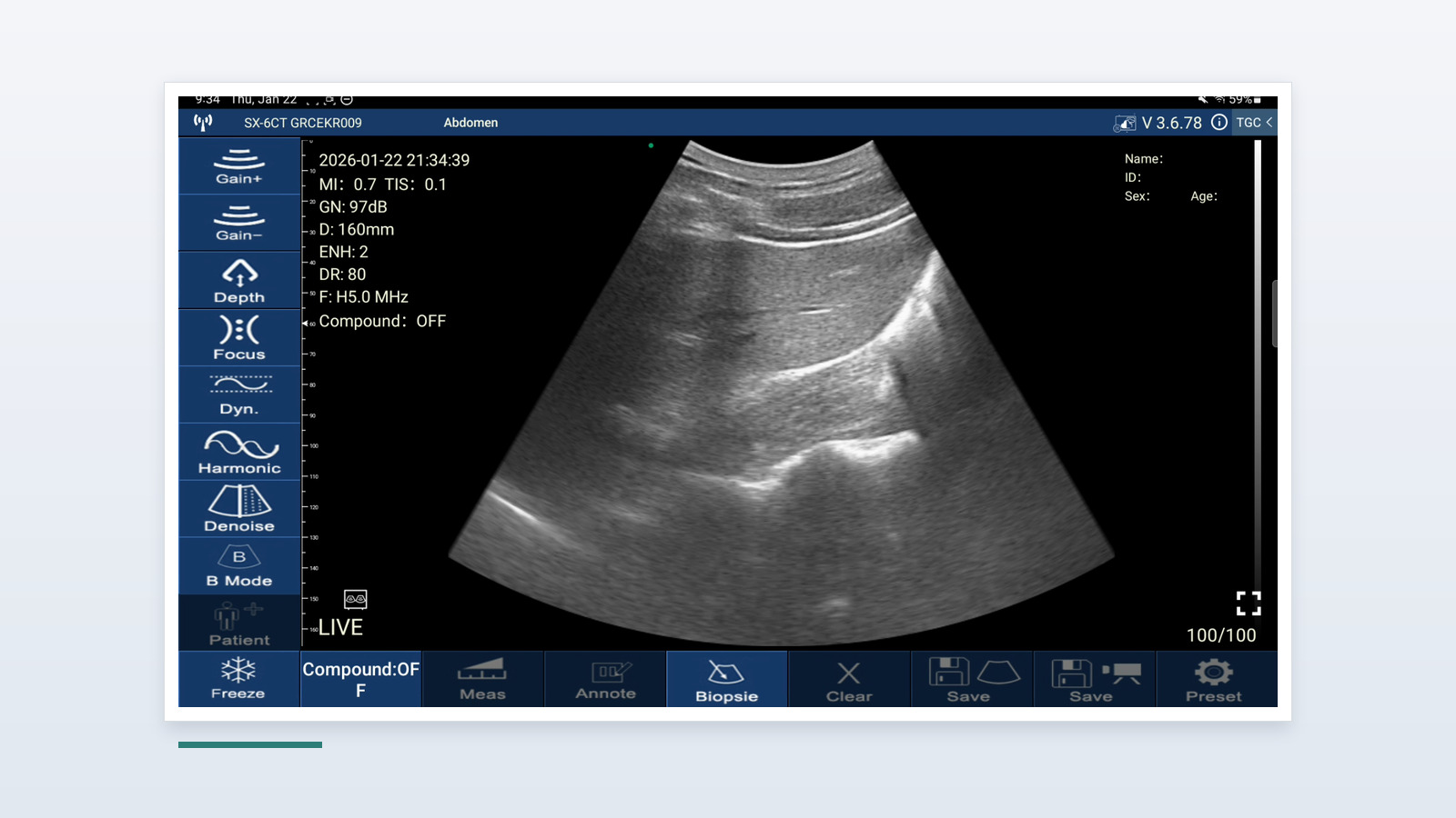 Suresult D3Ultra handheld echografie-interface die een scan van het rechter bovenkwadrant toont: lever, rechternier en de hepatorenale recessus, met de Abdomen-preset, 160 mm diepte en 97 dB gain op het paneel