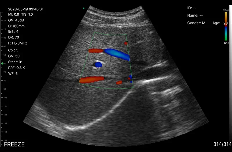 Color Doppler inside a liver on a Suresult D3Ultra at H5.0 MHz, 160 mm depth, with hepatic vessels filled red and blue