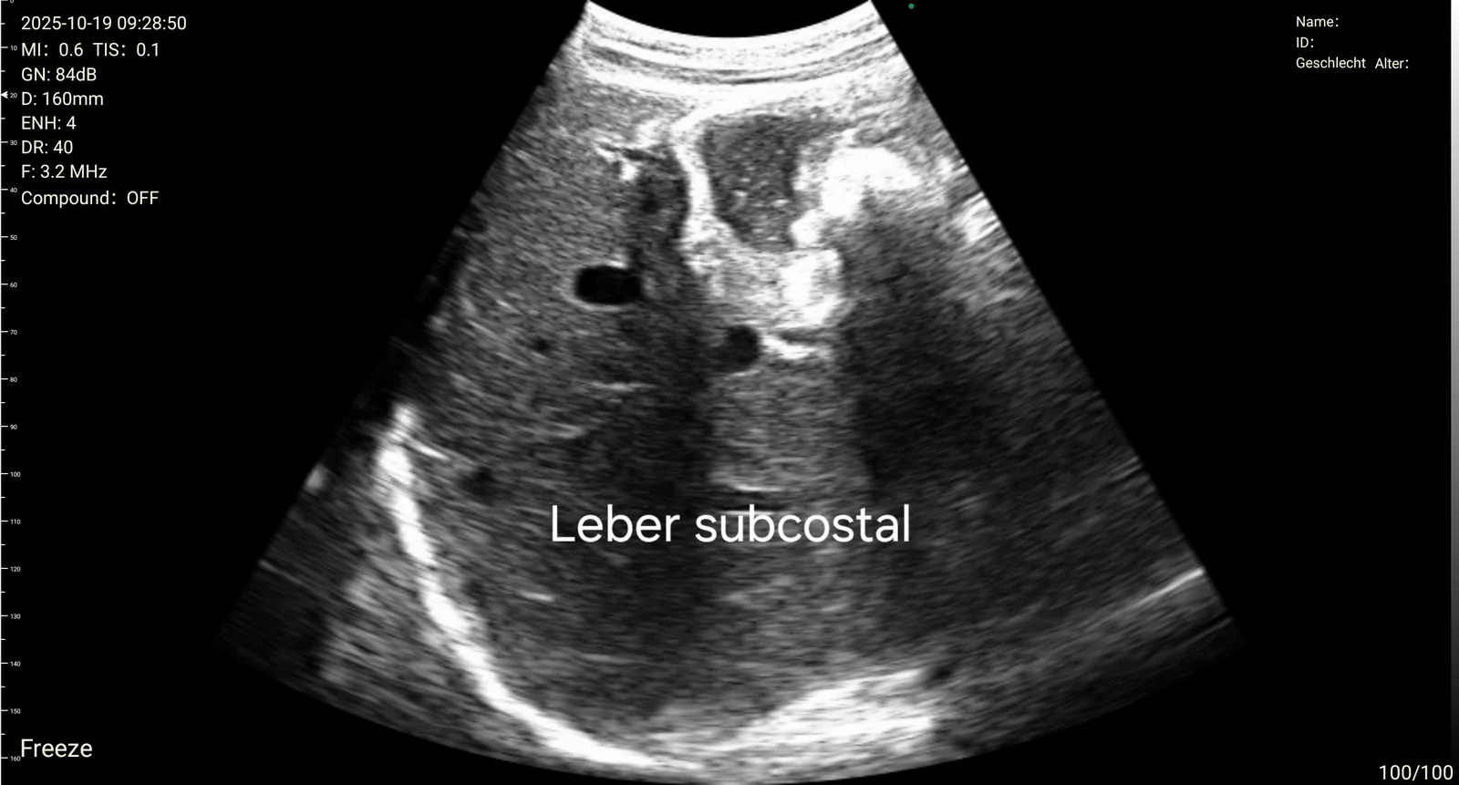 Subcostal liver window on the D3Ultra