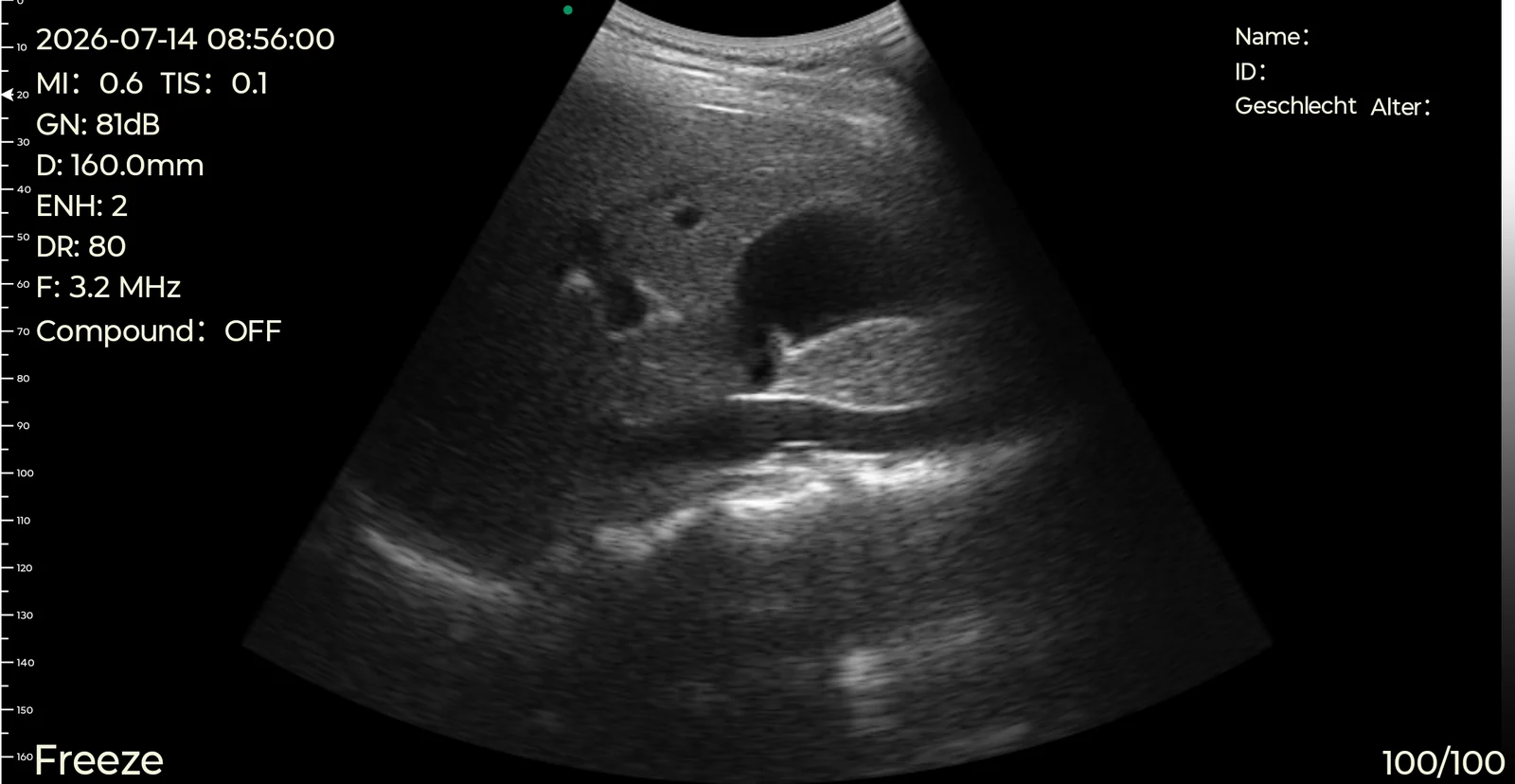 Long-axis gallbladder on the D3Ultra