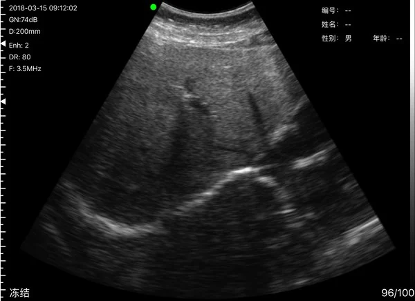 Bright liver recorded as fatty change