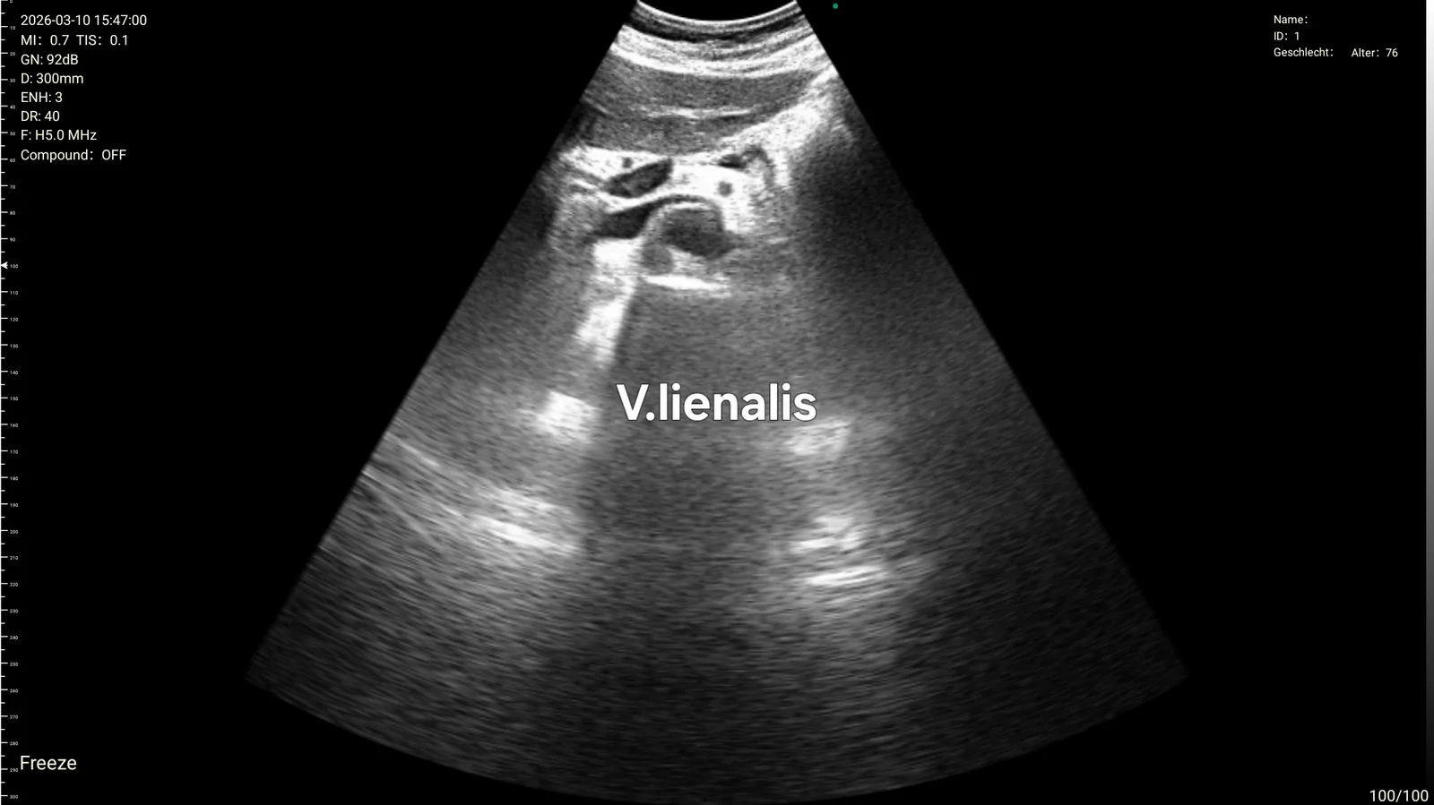 Splenic vein with the depth scale at 300 mm