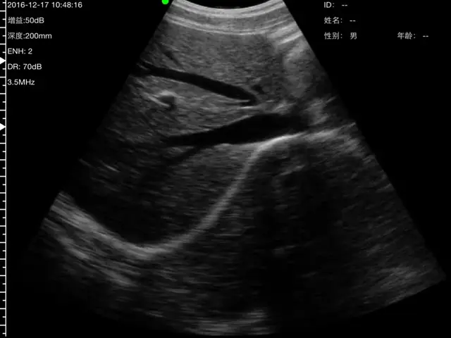 Hepatic vein sweep