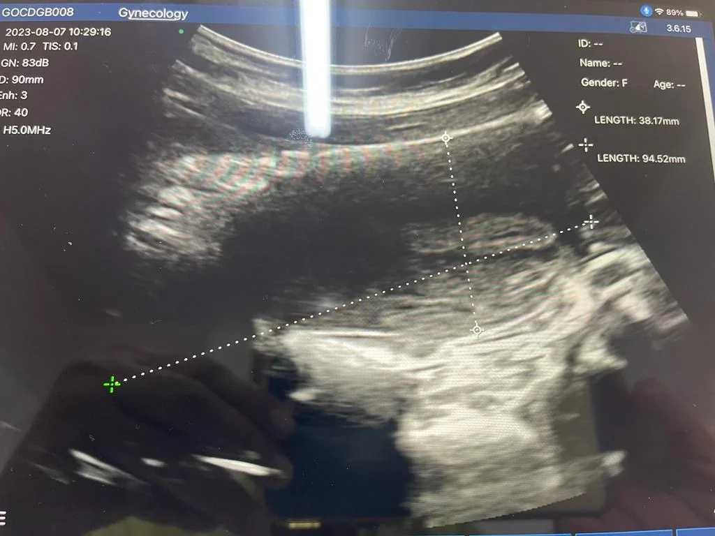 Transabdominal pelvic overview, 38.17 mm and 94.52 mm