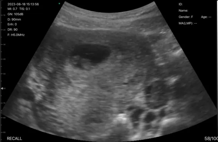 Transabdominal sweep on the convex head at 90 mm, 8 seconds
