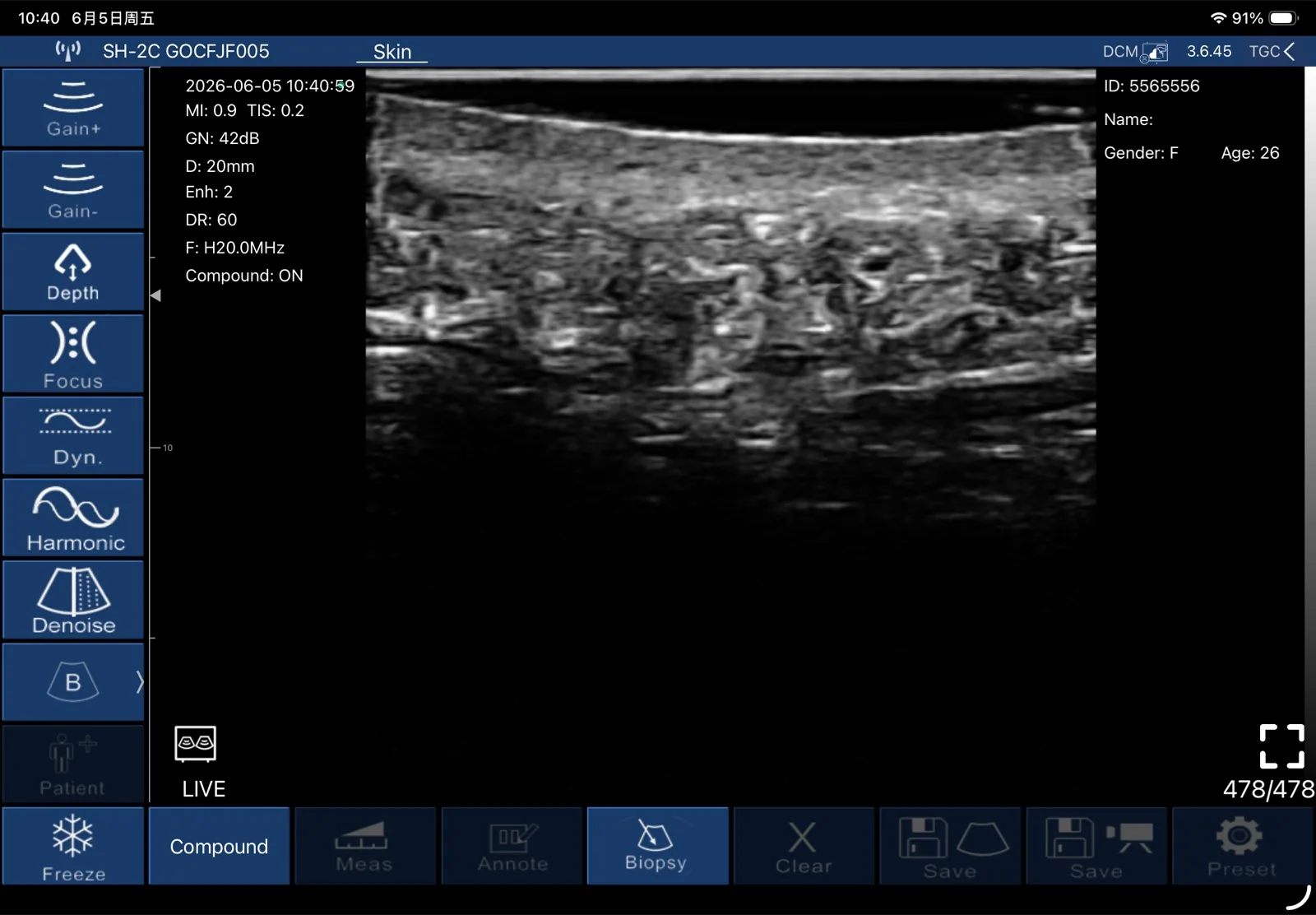 B-mode ultrasound at 20 MHz resolving the epidermis, dermis and subcutaneous tissue as distinct layers