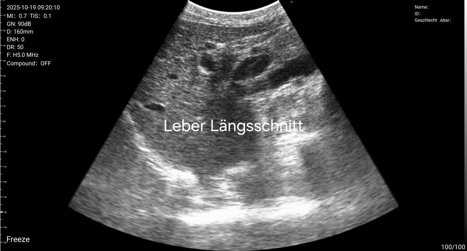 Liver longitudinal ultrasound view captured with Suresult D3Ultra handheld, 5.0 MHz