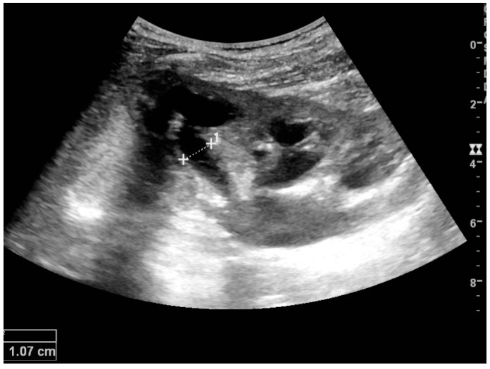 Hydronephrosis ultrasound thumbnail