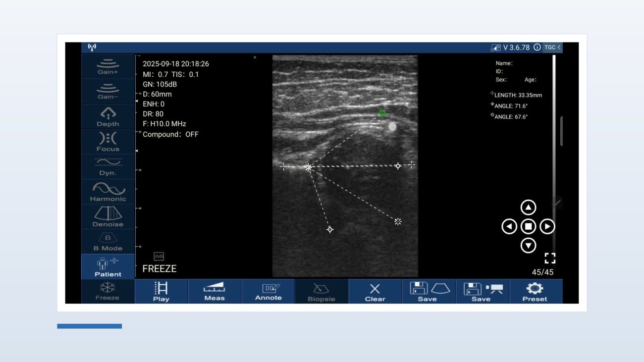 Coronal infant hip image frozen on a Suresult D3Ultra with the Graf baseline and bony roof line drawn on it, the device reading ANGLE 71.6 degrees at 60 mm depth and H10.0 MHz