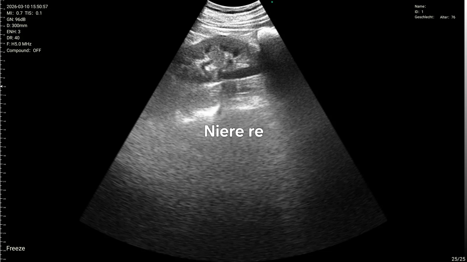 Right kidney at 300 mm on the D3Ultra