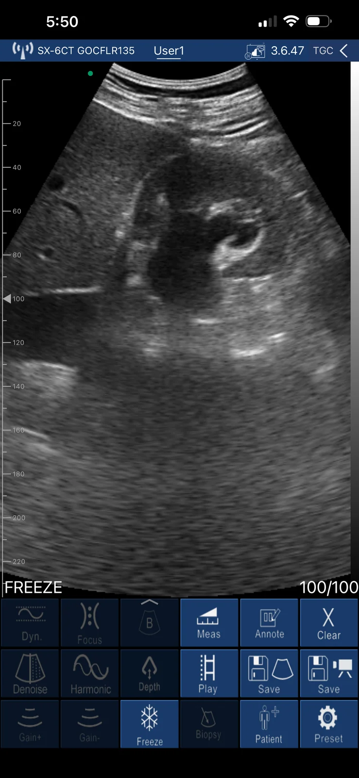 Dilated right renal collecting system on a Suresult convex head