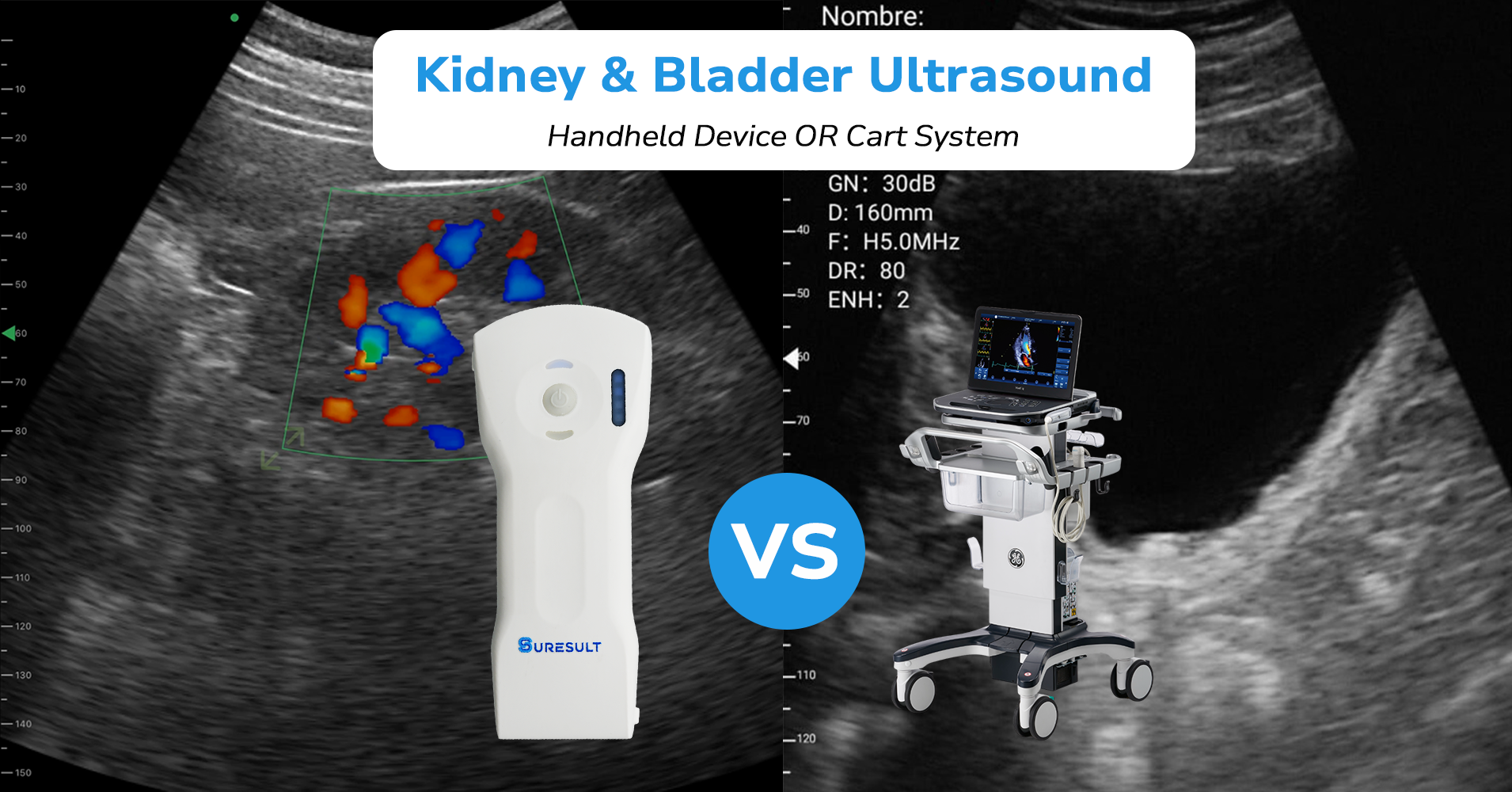 kidney and bladder ultrasound handheld device vs cart system