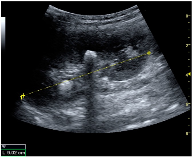 Renal stone with posterior shadowing ultrasound thumbnail