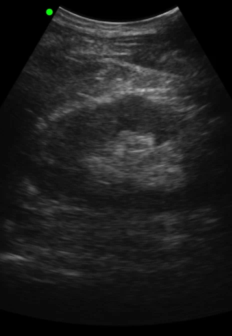 Renal B-mode reference