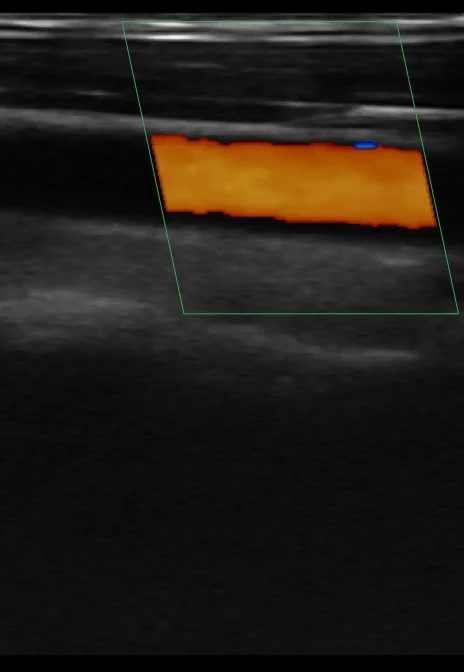 Carotid color-flow reference
