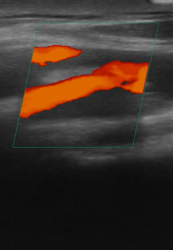 Power Doppler filling vessels on the handheld ultrasound