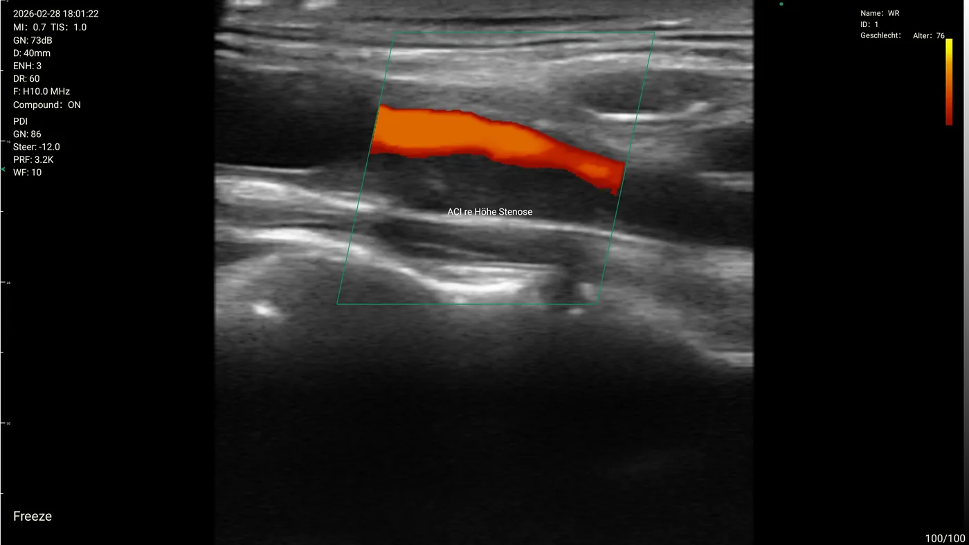 Carotid Power Doppler reference