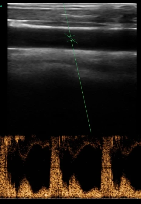 Carotid PW spectrum reference
