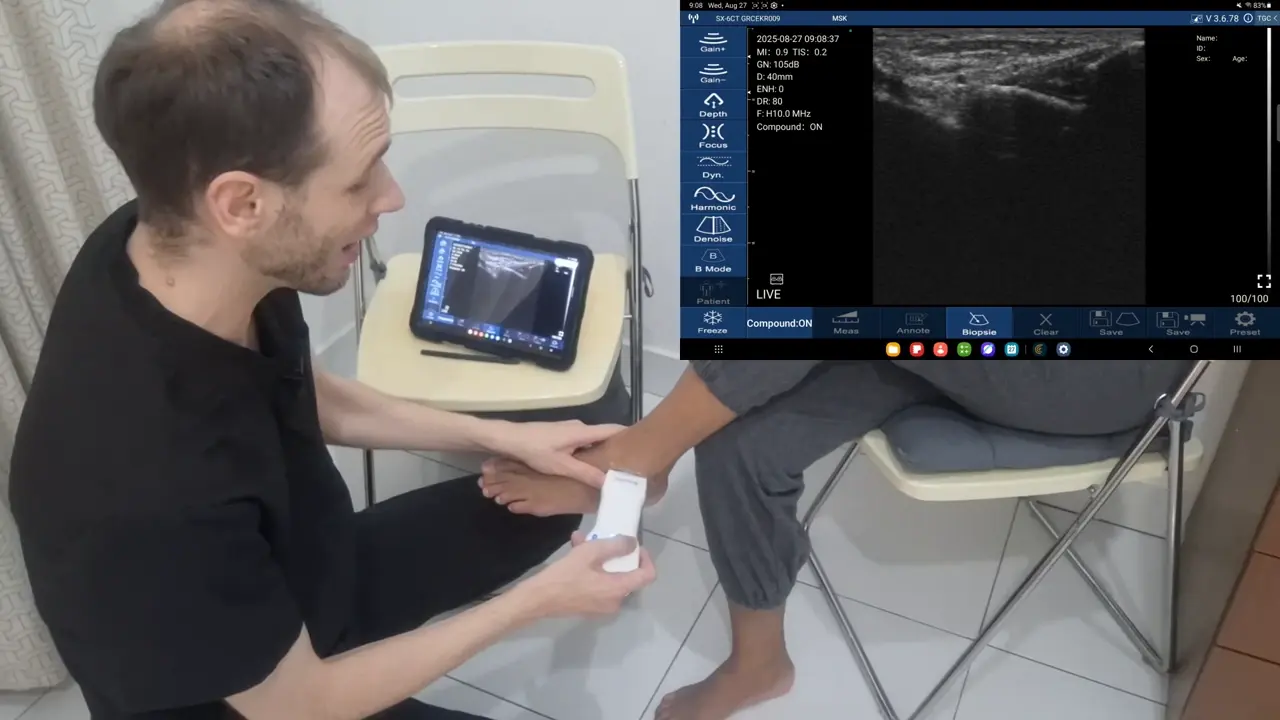 ATFL after a lateral ankle sprain