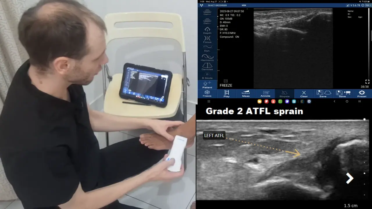 ATFL after a lateral ankle sprain