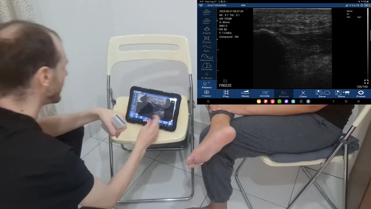 Plantar fascia at the calcaneal origin