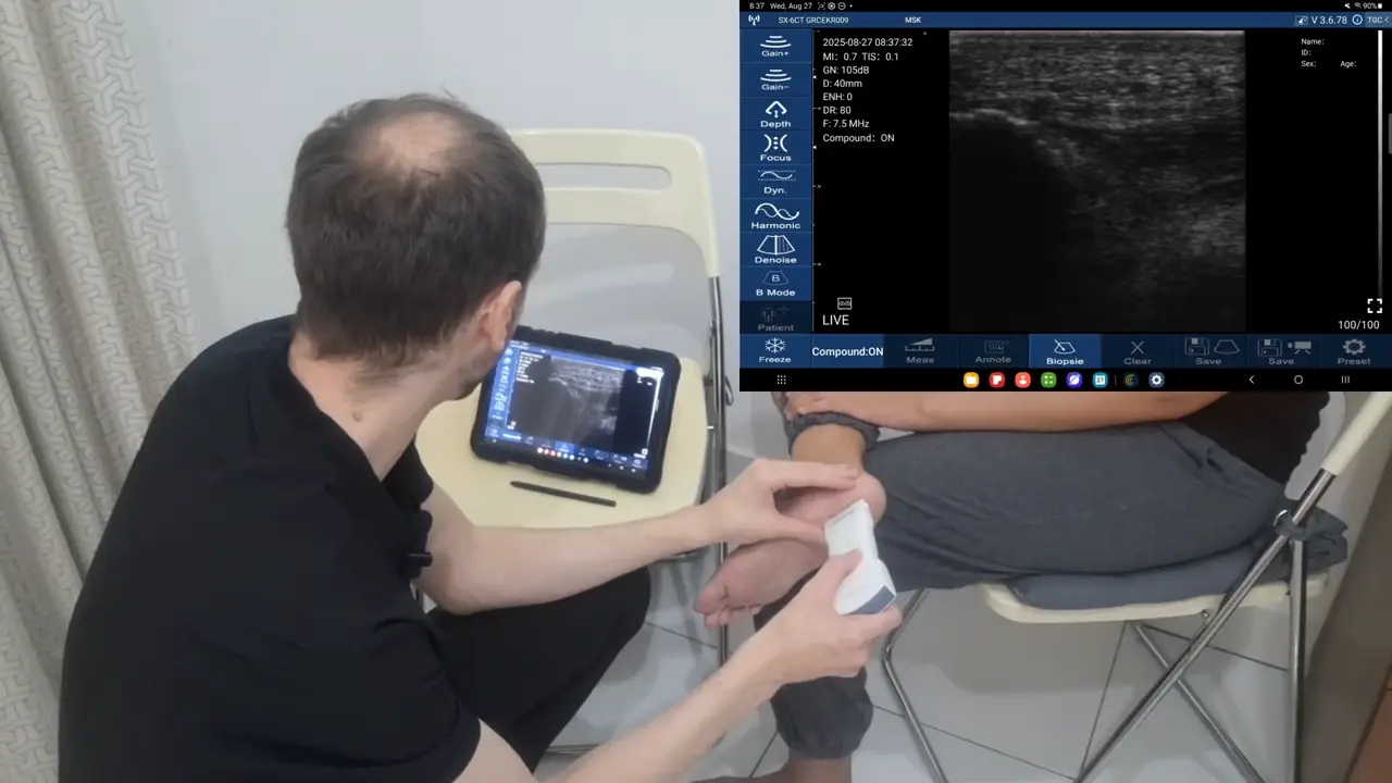 Plantar fascia at the calcaneal origin