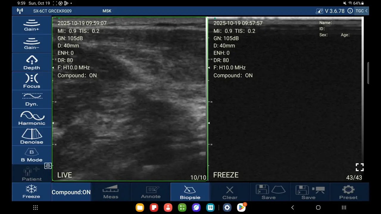 Elbow UCL, live beside a frozen frame