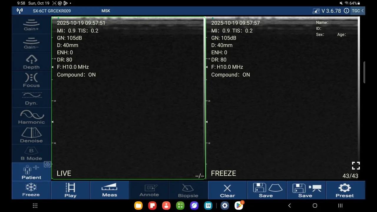 Elbow UCL, live beside a frozen frame