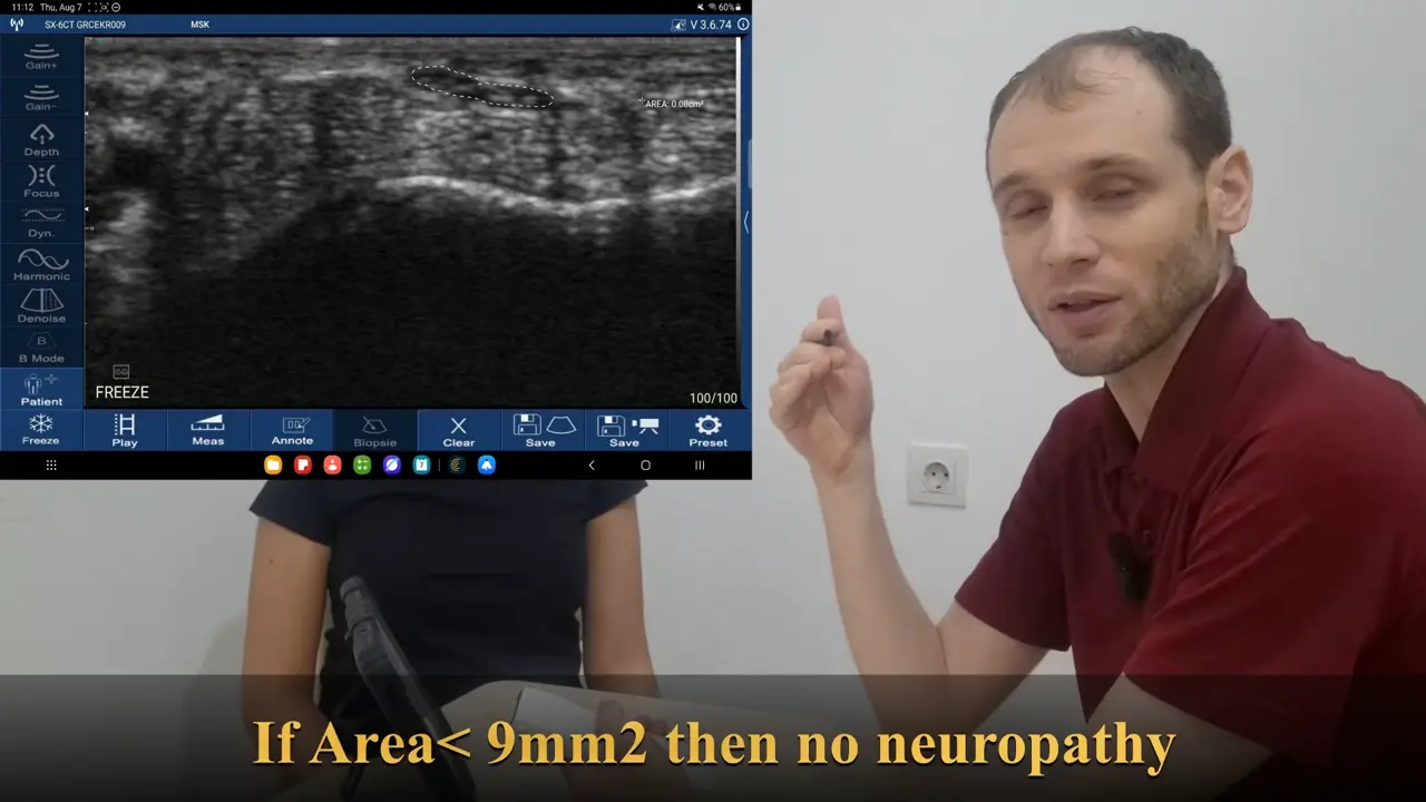 Median nerve at the carpal tunnel
