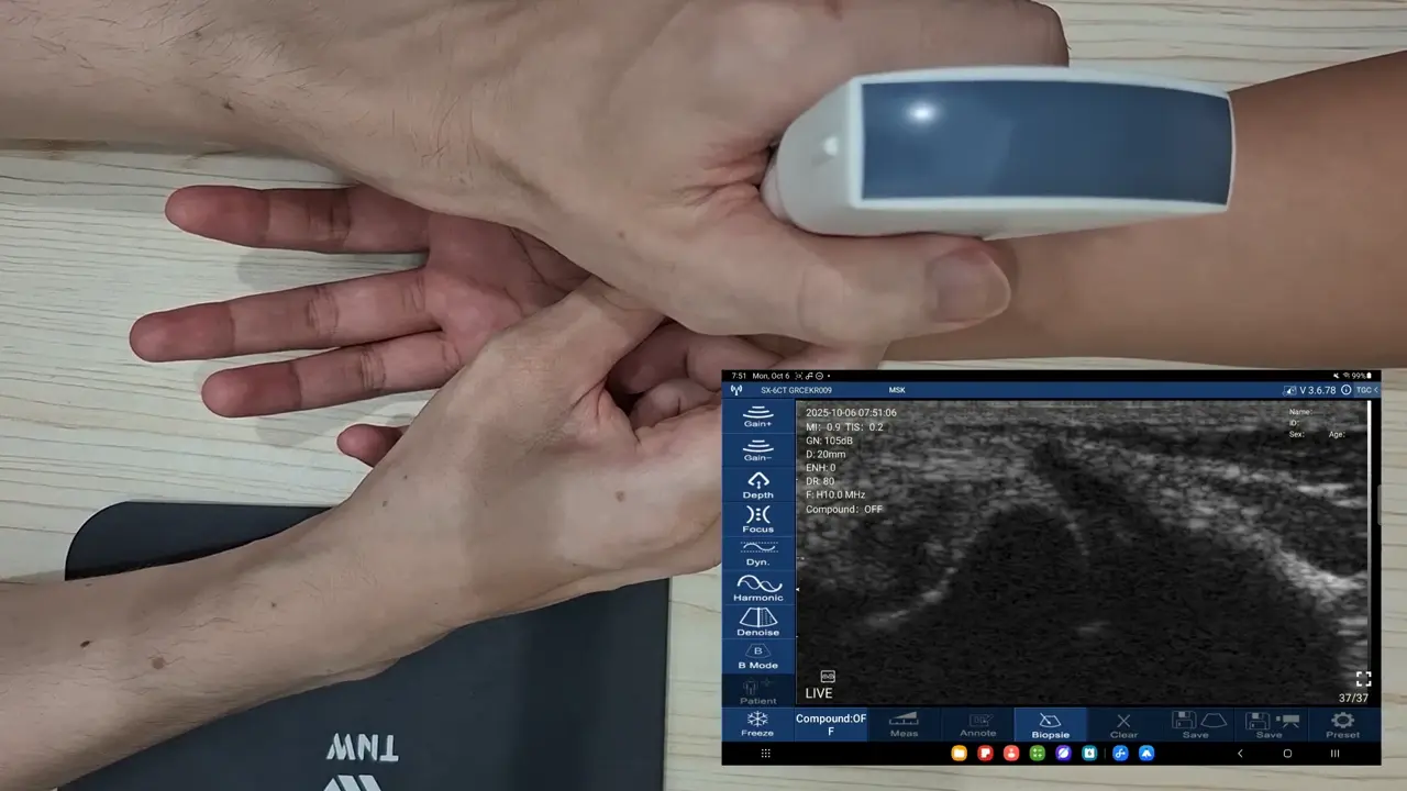 Scaphoid at the radial wrist