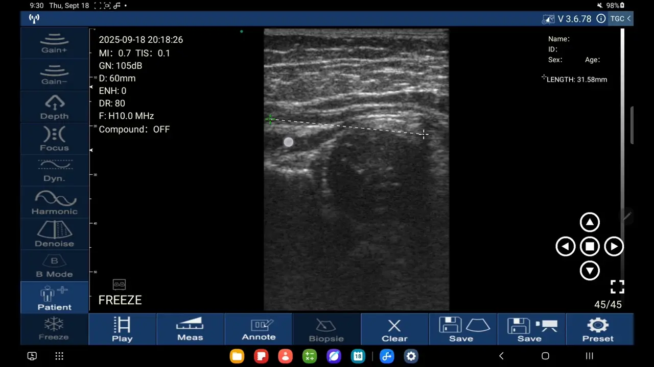 Infant hip, Graf method