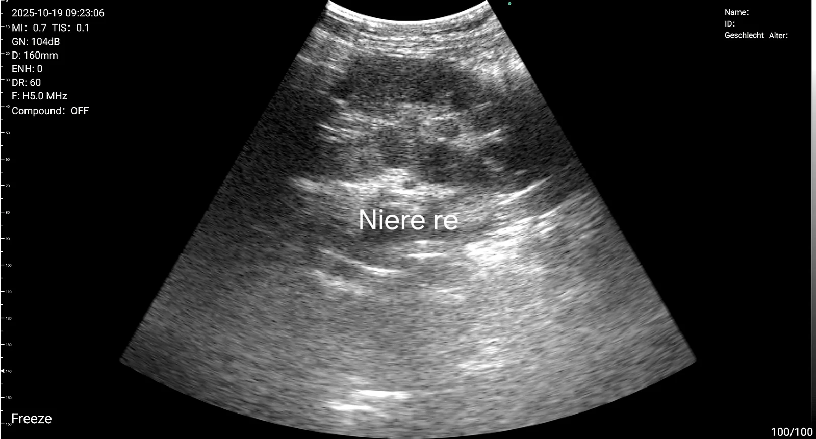 Nephrology: nephrology 02 second pass through right kidney d3ultra