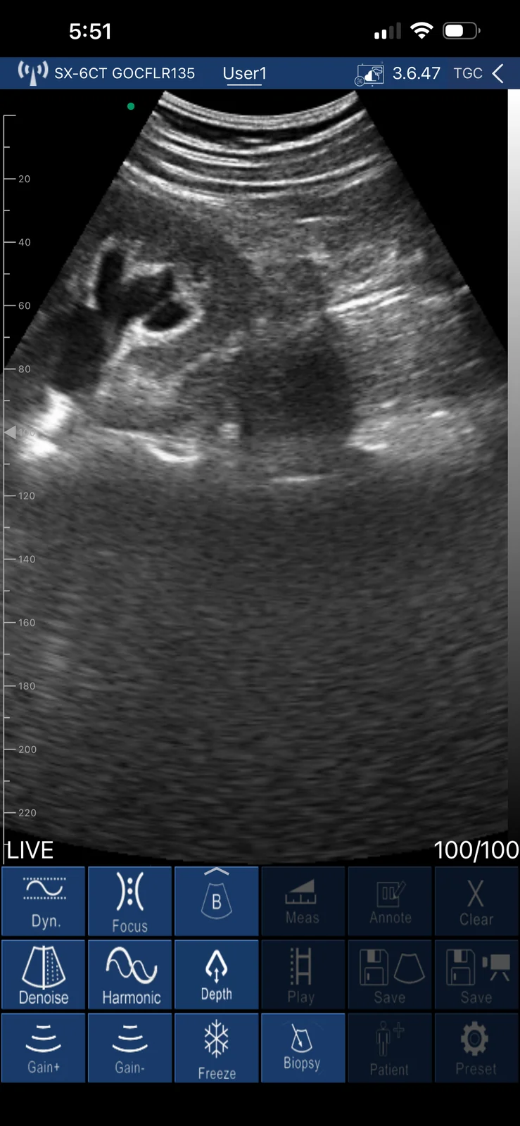 The same obstructed kidney, live