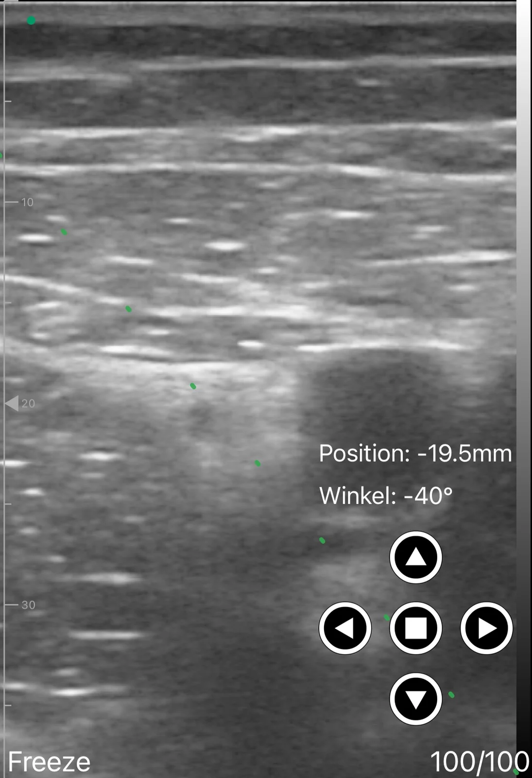 Saphenous nerve in the adductor canal