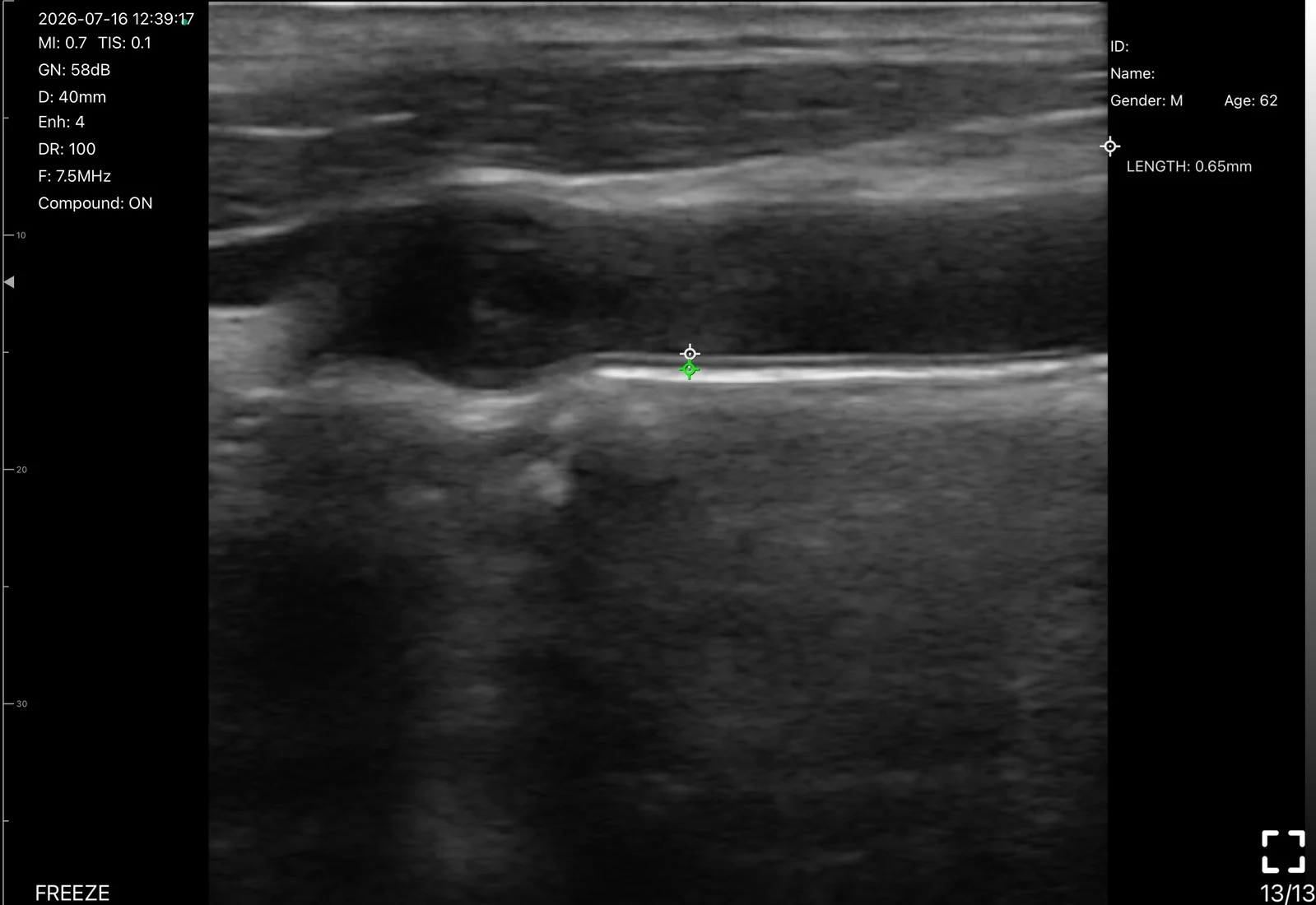 Common carotid intima-media thickness on the D3Ultra