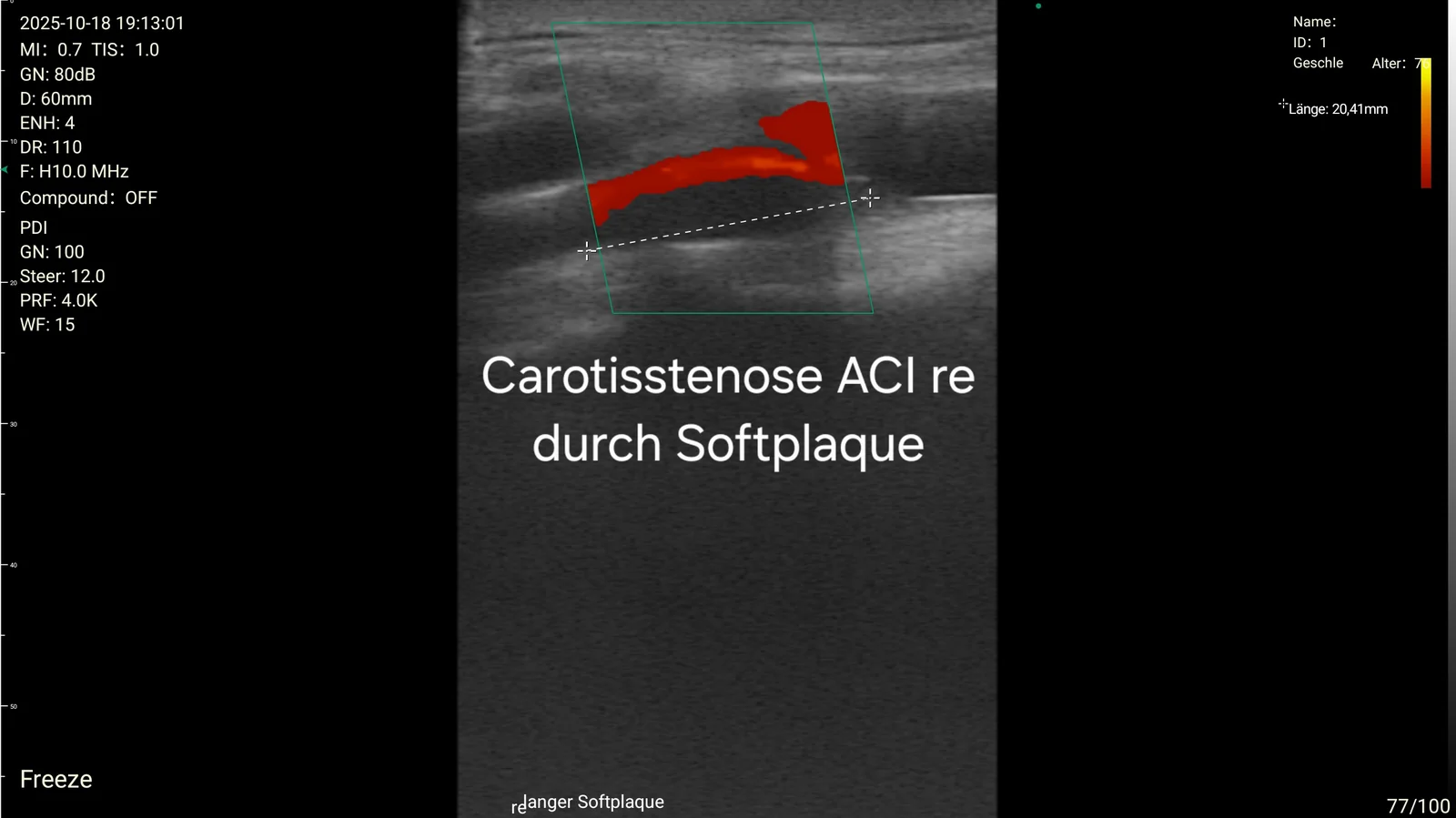 Right internal carotid stenosis from soft plaque