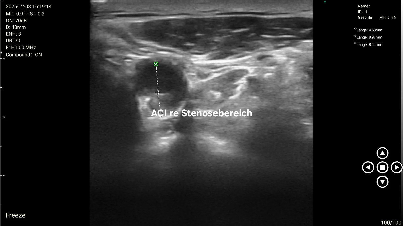 Plaque measured inside the right internal carotid