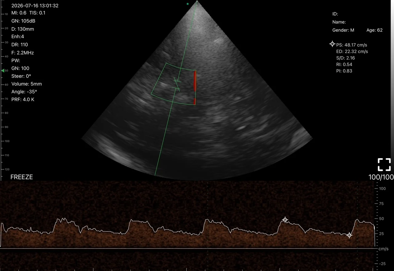 Transtemporal midbrain with pulsed-wave Doppler of the right posterior cerebral artery