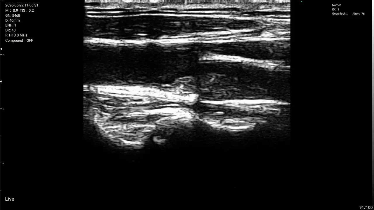 Interscalene brachial plexus, live sweep