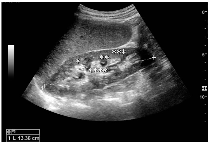Annotated normal adult kidney ultrasound showing cortex, pyramid, column of Bertin and renal sinus