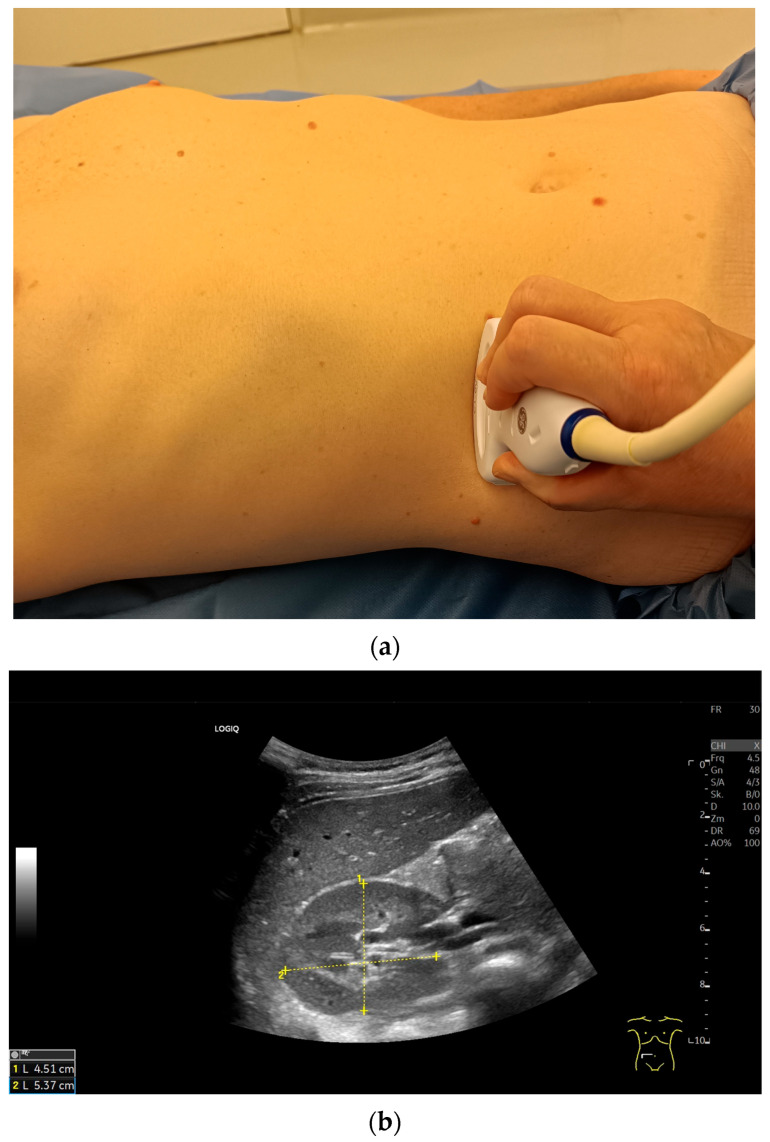 Transverse right kidney ultrasound with probe position and width measurements