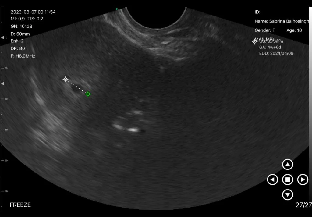 Obstetrics: obstetrics 02 gestational sac 4w 6d endocavity head